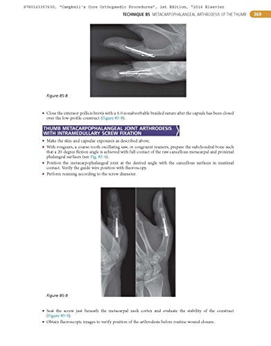 Campbell's Core Orthopaedic Procedures [Hardcover] Canale MD, S. Terry; Beaty MD, James H. and Azar MD, Frederick M.